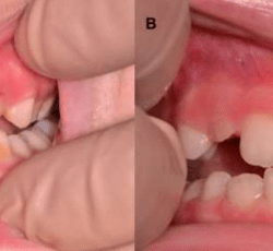 Emphysema gum disease skin discoloration and leukemia